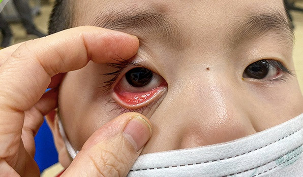 Nhiều trẻ mắt bị sưng húp, đỏ ngầu, biến chứng do đau mắt đỏ