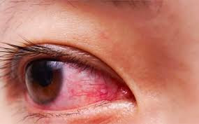 Dịch bệnh đau mắt đỏ bùng phát, Bến Tre chỉ đạo các giải pháp ứng phó