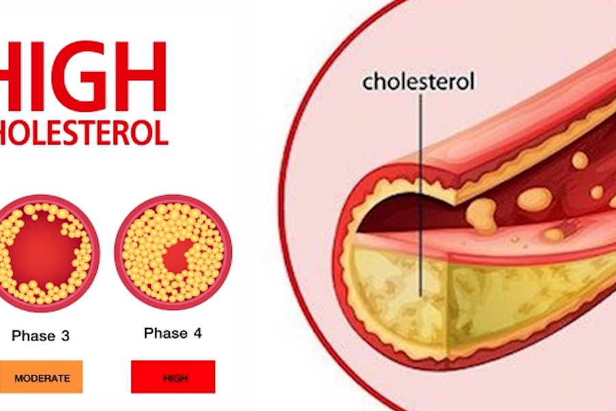 6 dấu hiệu của cơ thể báo động cholesterol máu cao