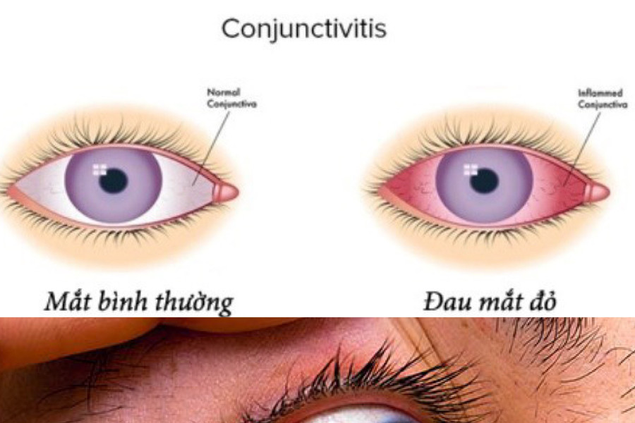 Bác sĩ khuyến cáo không được đắp các loại lá vào mắt khi bị đau mắt đỏ