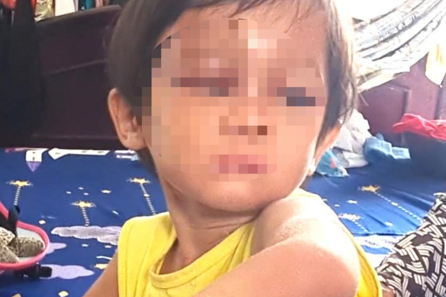 Bé gái 4 tuổi nghi bị cha nuôi bạo hành