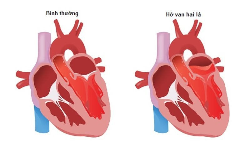 Hở van tim mạch có thể chữa khỏi bằng thuốc không?