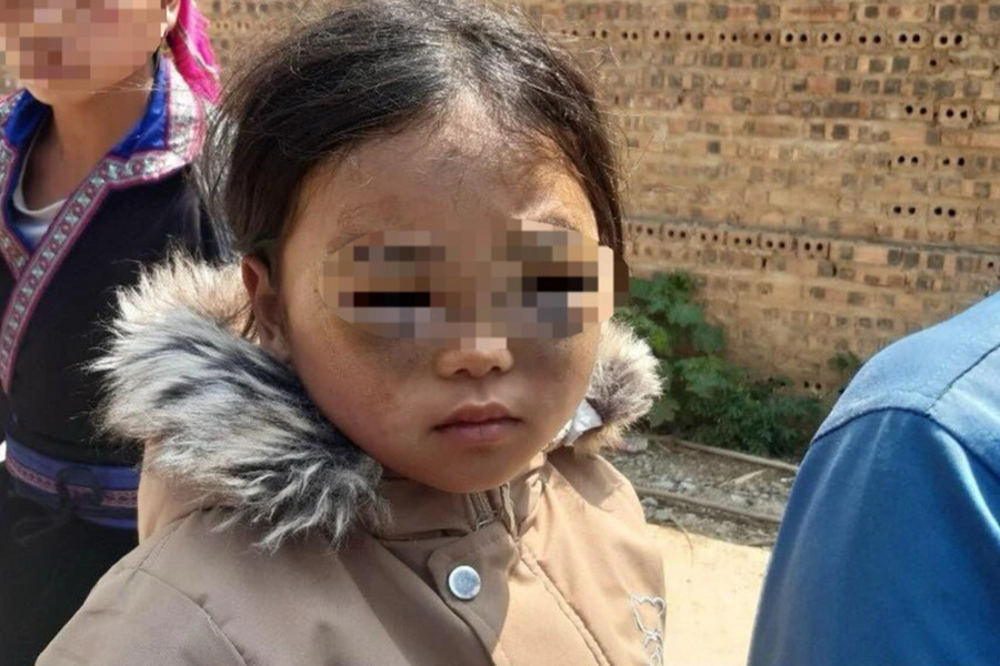 Tạm đình chỉ giáo viên nghi đánh bé gái lớp 1 thâm tím 2 mắt ở Yên Bái