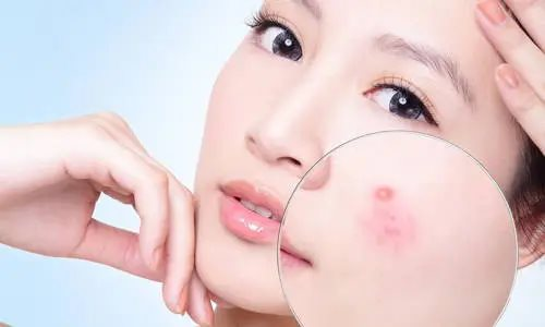 Cây Rơm Cosmetic chia sẻ thông tin hữu ích cho làn da bị mụn