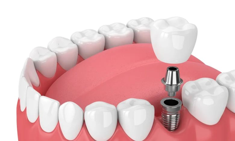 Trải nghiệm dịch vụ trồng răng implant chất lượng tại Bệnh viện Răng Hàm Mặt Sài Gòn